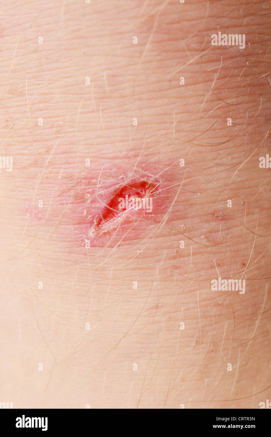 Scab scar hires stock photography and images Alamy