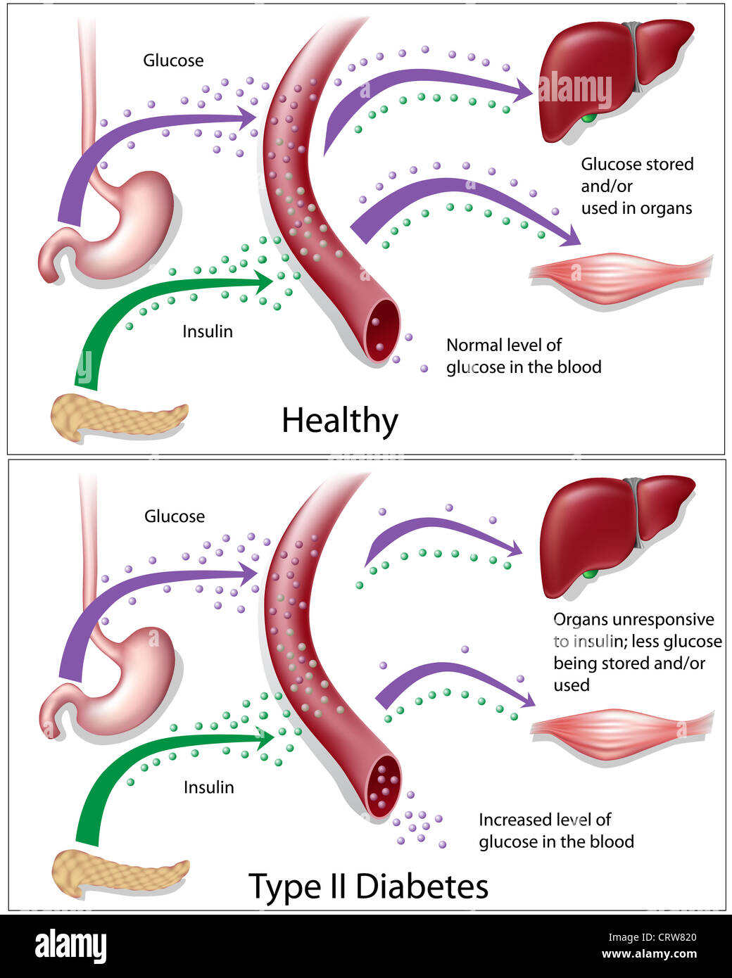 Diagram illustrating Type 2 diabetes versus healthy blood glucose levels Stock Photo