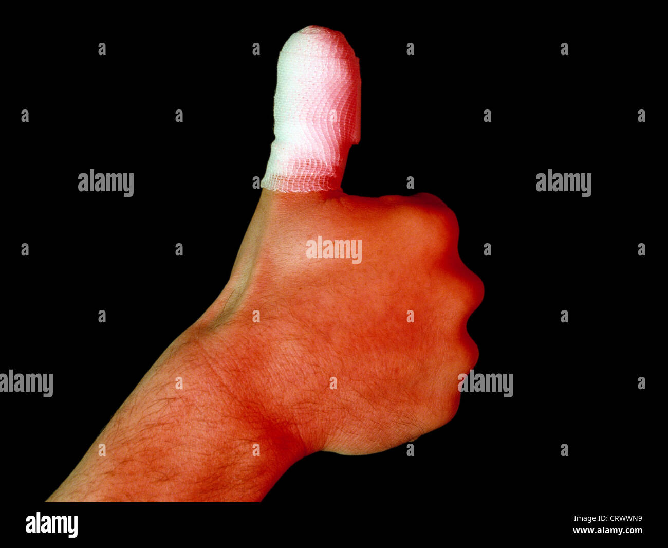 Injured and provided with a dressing thumb Stock Photo