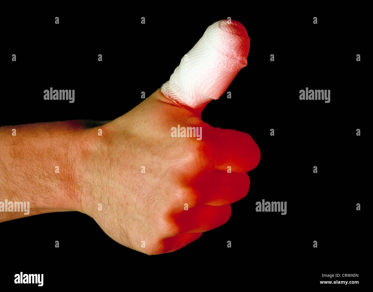 Injured and provided with a dressing thumb Stock Photo