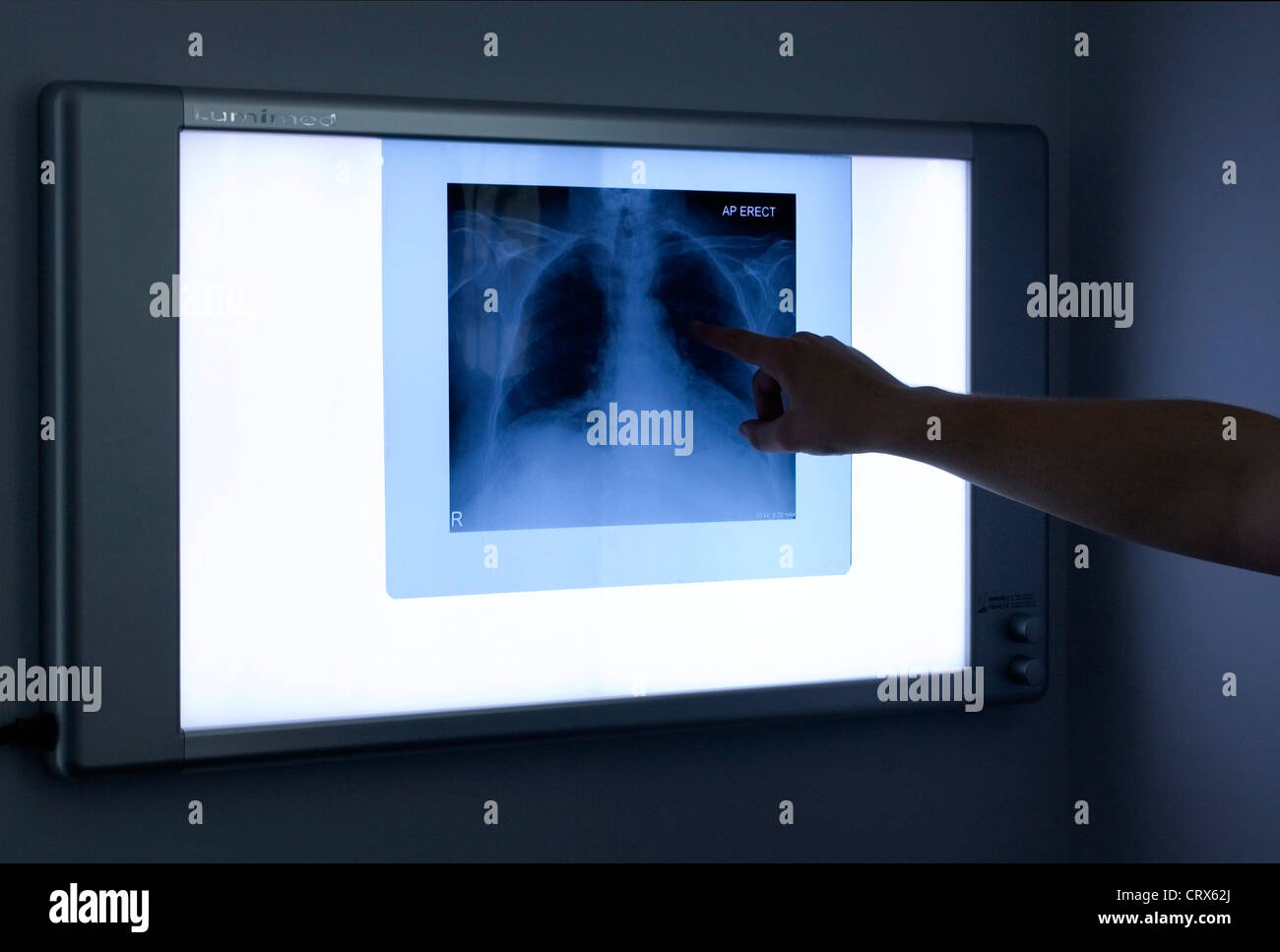 An x-ray of a patient's chesst being reviewed on an illuminated wall-mounted monitoring screen Stock Photo