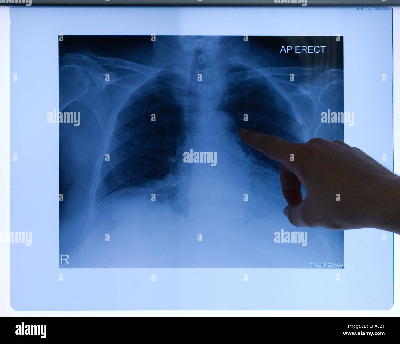 An x-ray of a patient's chest being reviewed on an illuminated wall-mounted monitoring screen Stock Photo