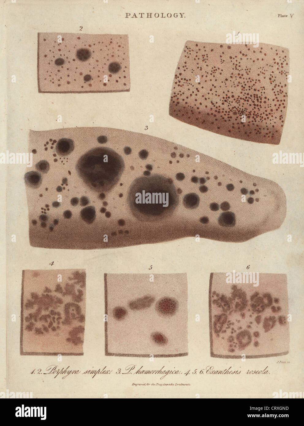 Skin diseases: Purple spots, Purpura simplex and P. haemorrhagica and rose rash, Exanthesis roseola. Stock Photo