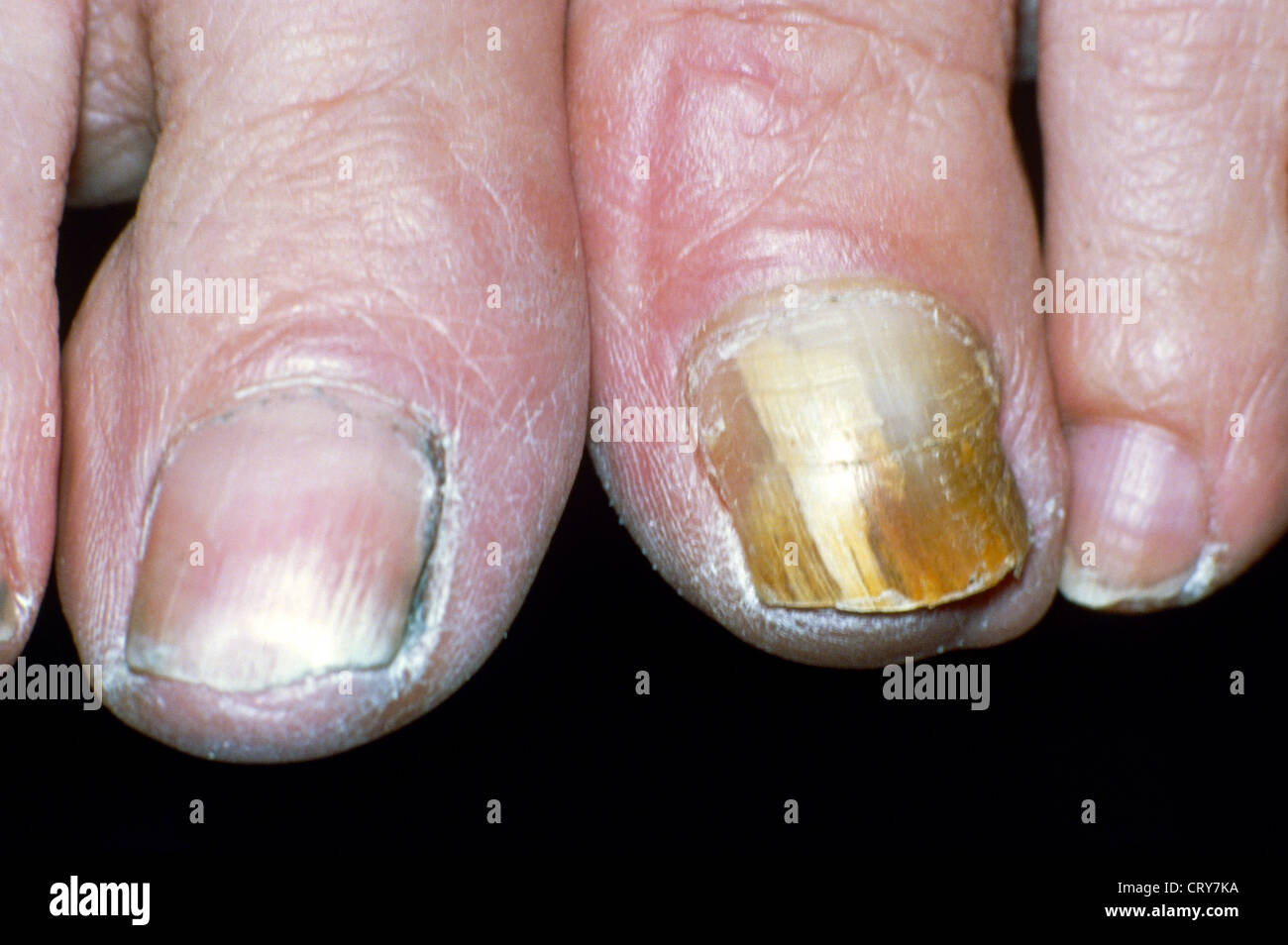 Mycotic nails hires stock photography and images Alamy