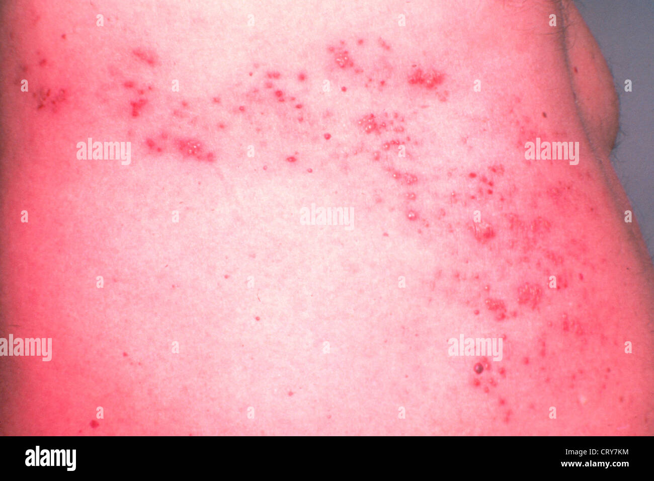 Herpes zoster hi-res stock photography and images - Alamy
