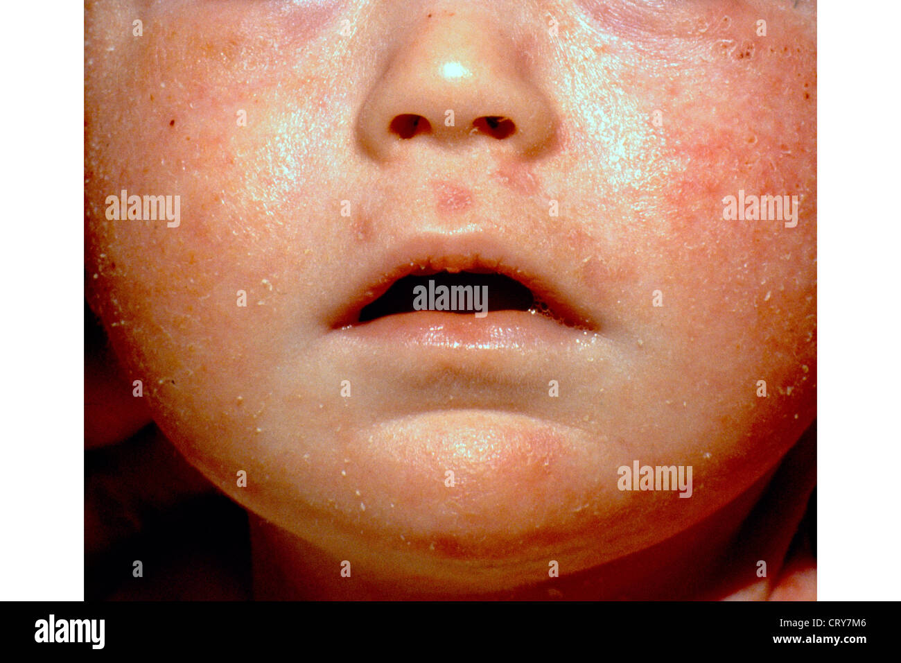 Candidiasis candidose spruw Candida Voedingscentrum