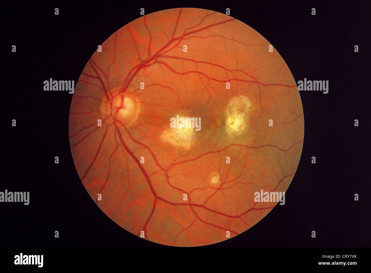 RETINAL CANDIDIASIS Stock Photo Alamy