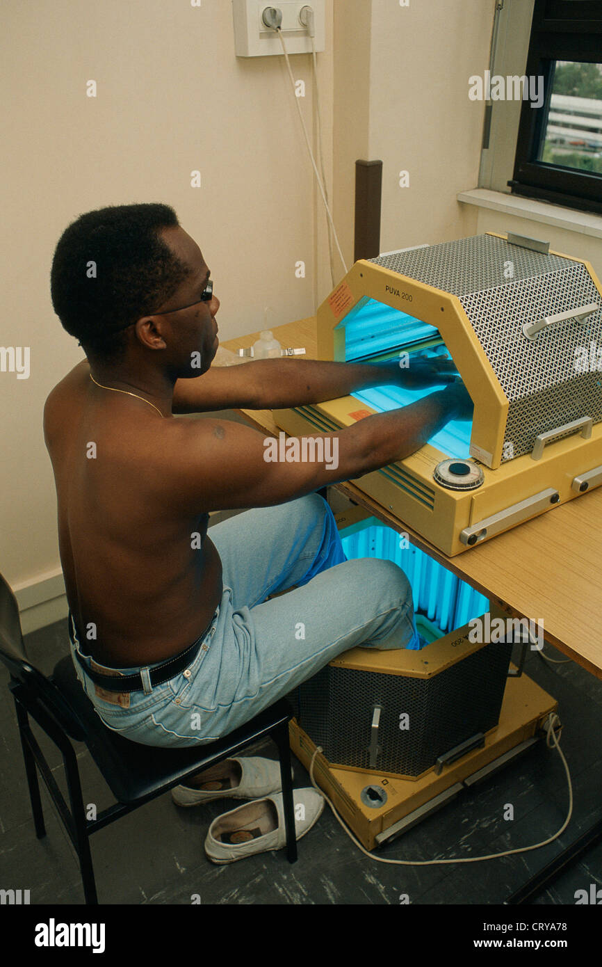PUVA THERAPY Stock Photo 49158572 Alamy