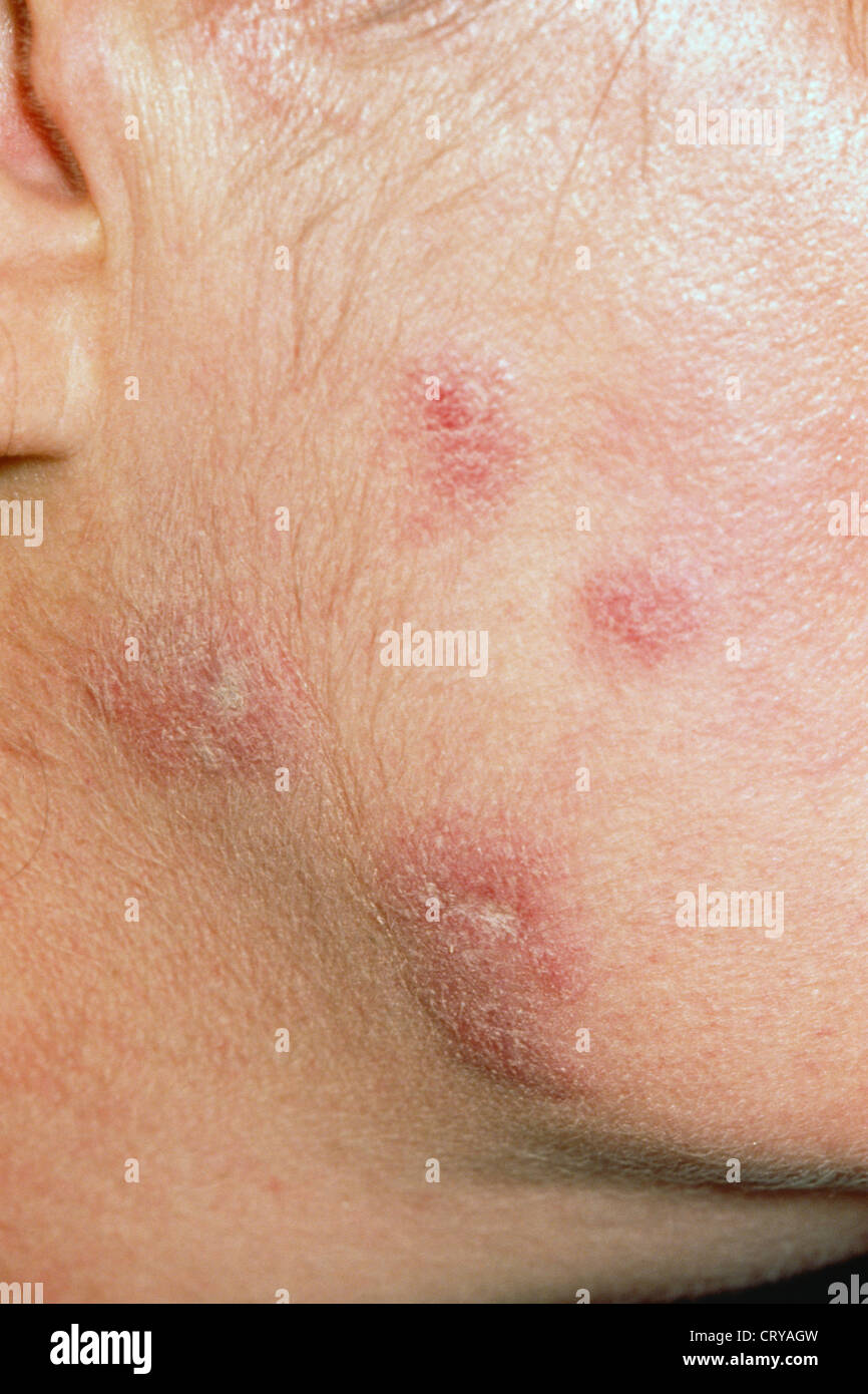 Facial discoid dermatosis hires stock photography and images Alamy
