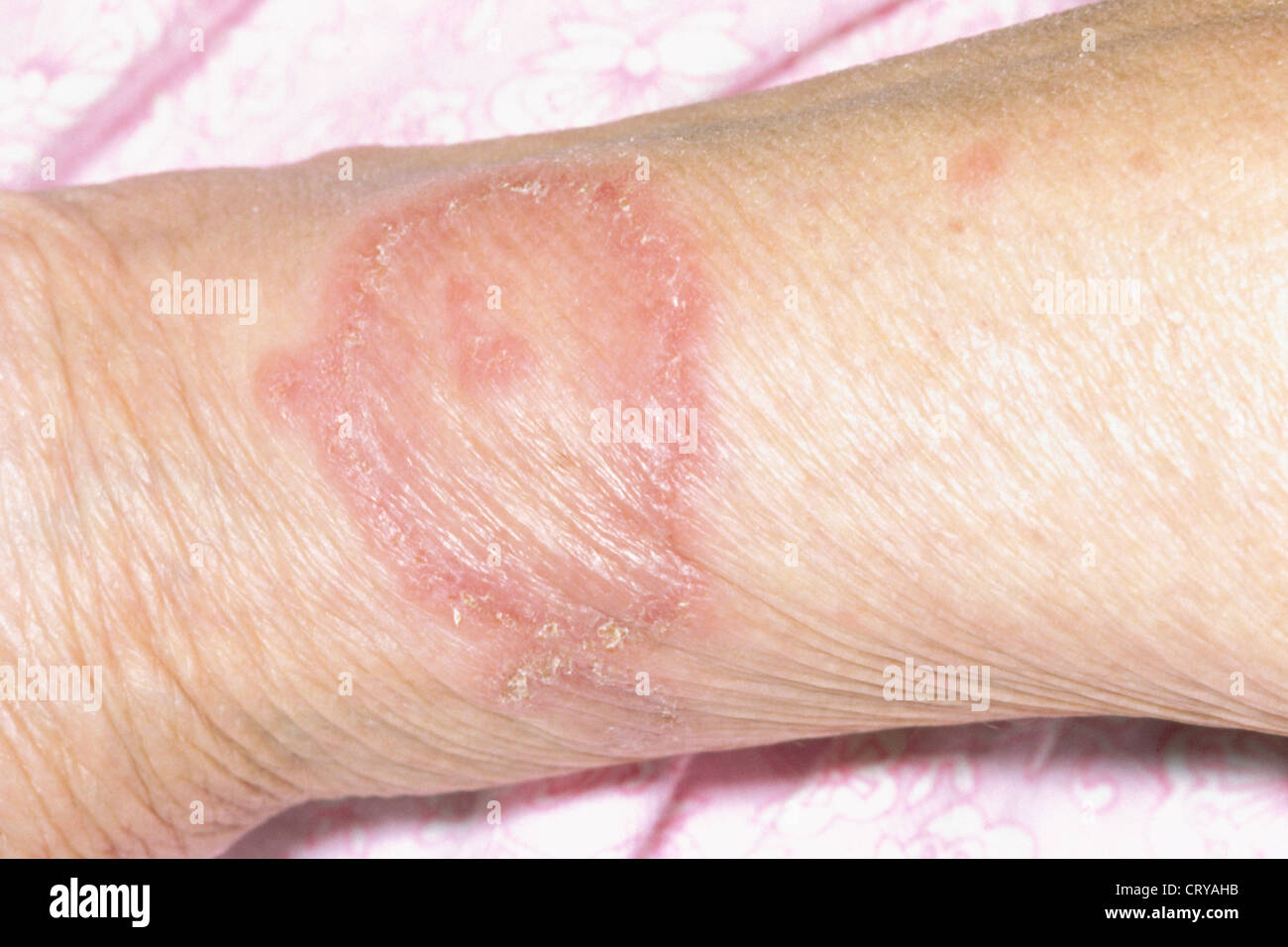 ERYTHEMA ANNULARE CENTRIFUGUM Stock Photo - Alamy