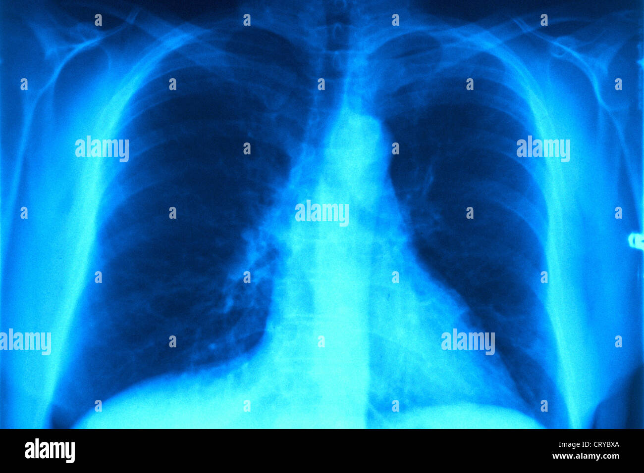 Interstitial Pneumonia X Ray