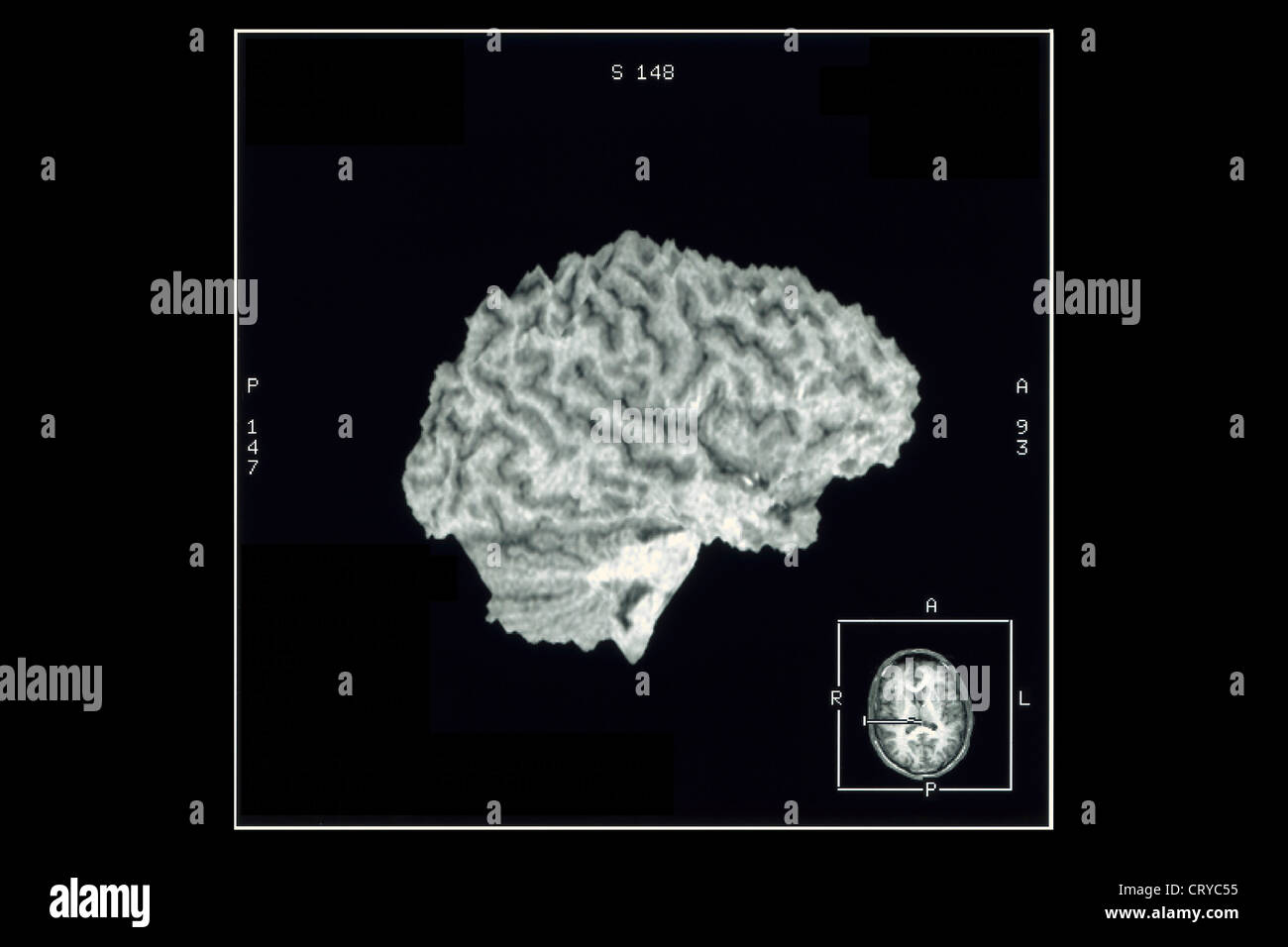 CEREBRAL CORTEX, MRI Stock Photo - Alamy