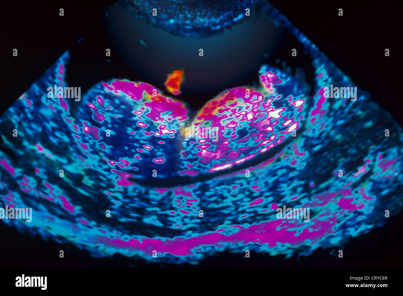 3 months fetus hi-res stock photography and images - Alamy