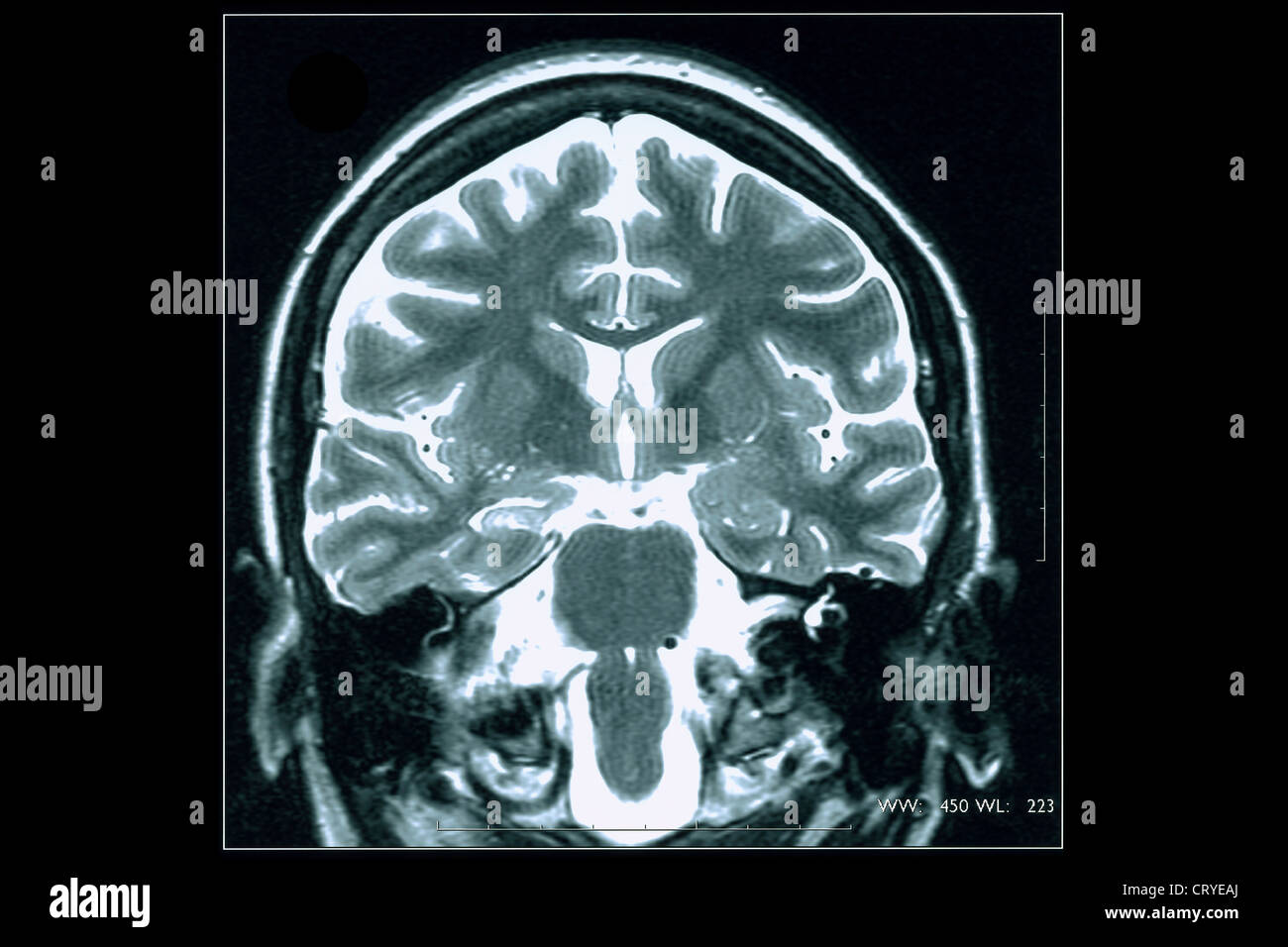 Epilepsy scan hi-res stock photography and images - Alamy