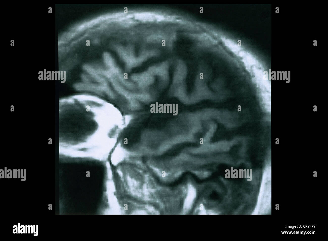 ALZHEIMER DISEASE, MRI Stock Photo Alamy