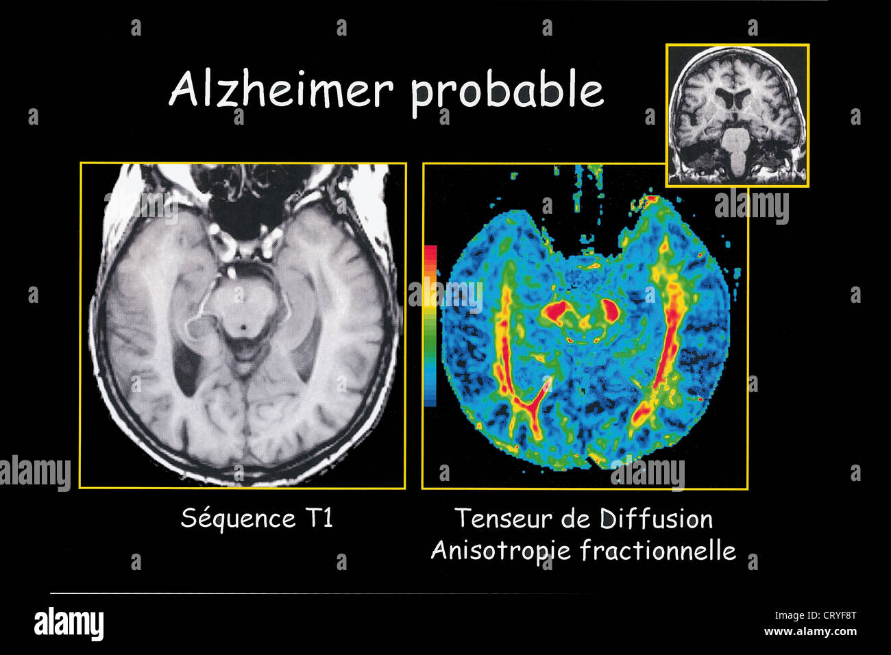 ALZHEIMER DISEASE, MRI Stock Photo