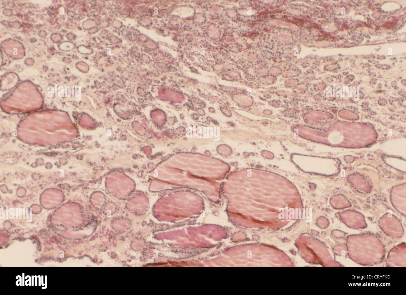 SEARCH AND BUY THIS PRODUCT Goiter Stock Photos & Goiter Stock Images - Alamy
