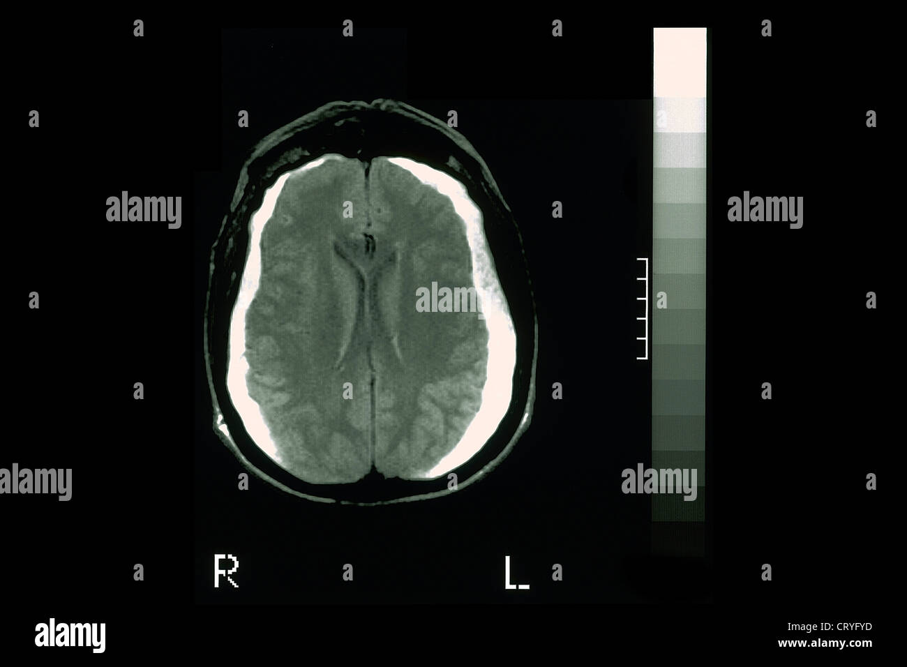 HEMATOMA, BRAIN MRI Stock Photo - Alamy