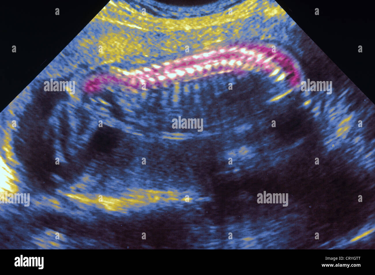 ULTRASOUND BIOMETRY OF THE FETUS Stock Photo - Alamy