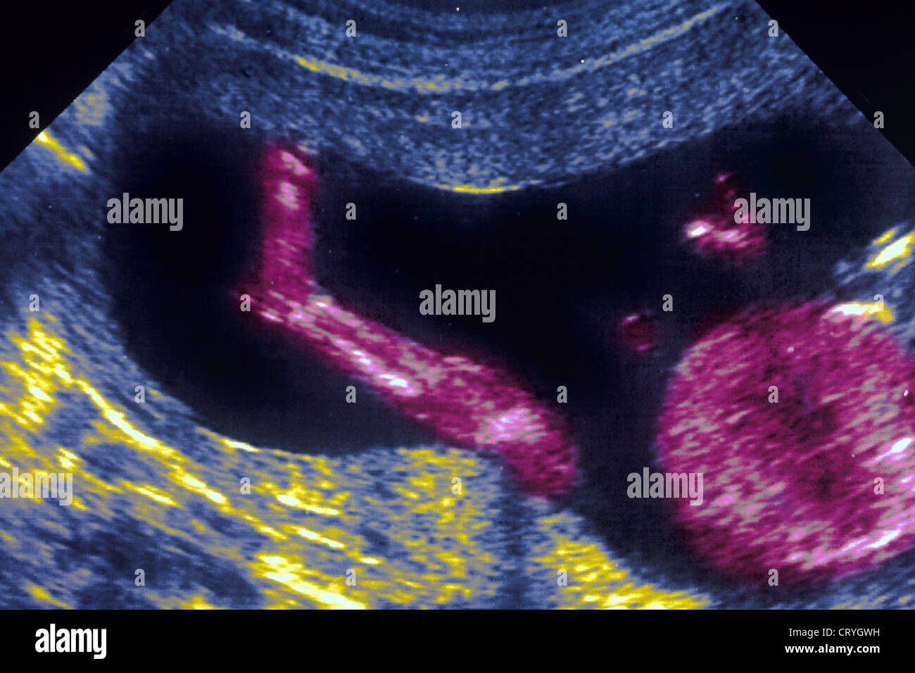 5 month fetus hi-res stock photography and images - Alamy