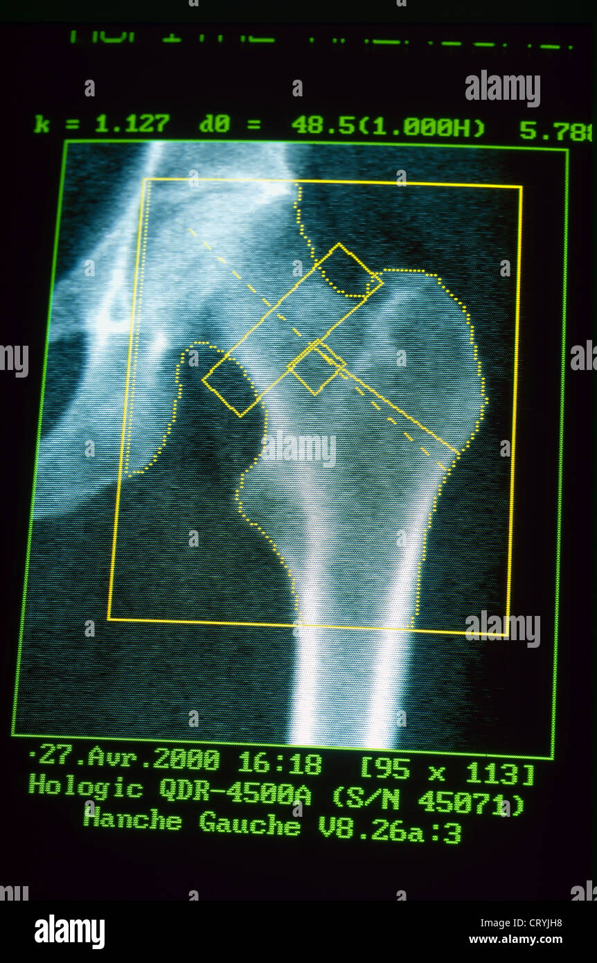 OSTEOPENIA Stock Photo: 49165124 - Alamy