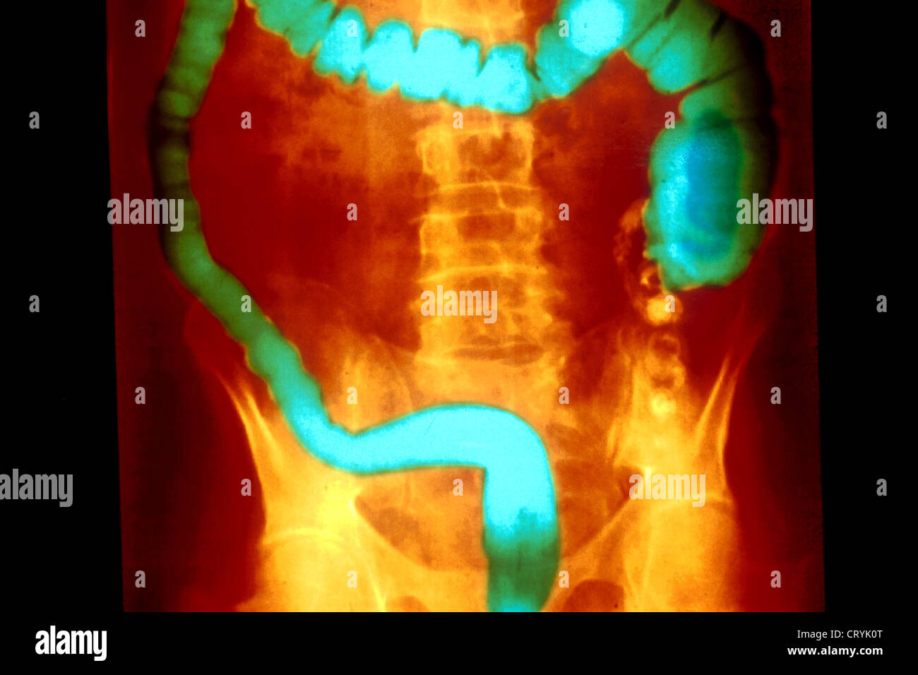 ULCERATIVE COLITIS, XRAY Stock Photo Alamy