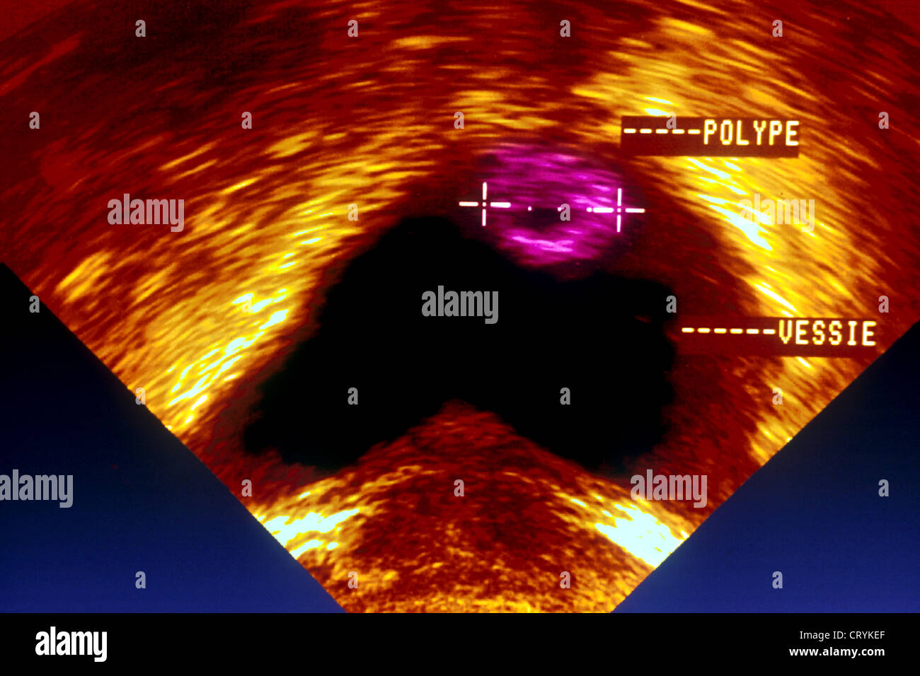 POLYP IN THE BLADDER, SONOGRAPHY Stock Photo