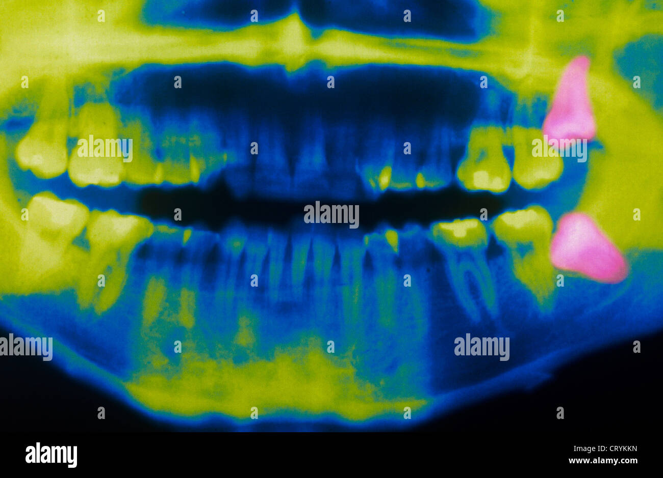 WISDOM TOOTH, X RAY Stock Photo Alamy