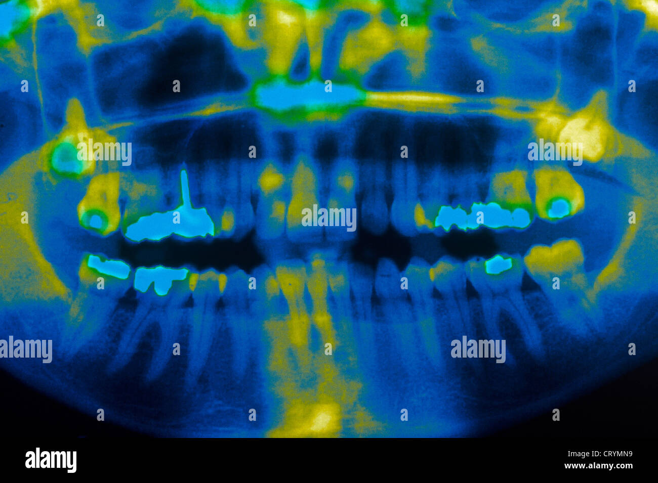 WISDOM TOOTH, X RAY Stock Photo - Alamy