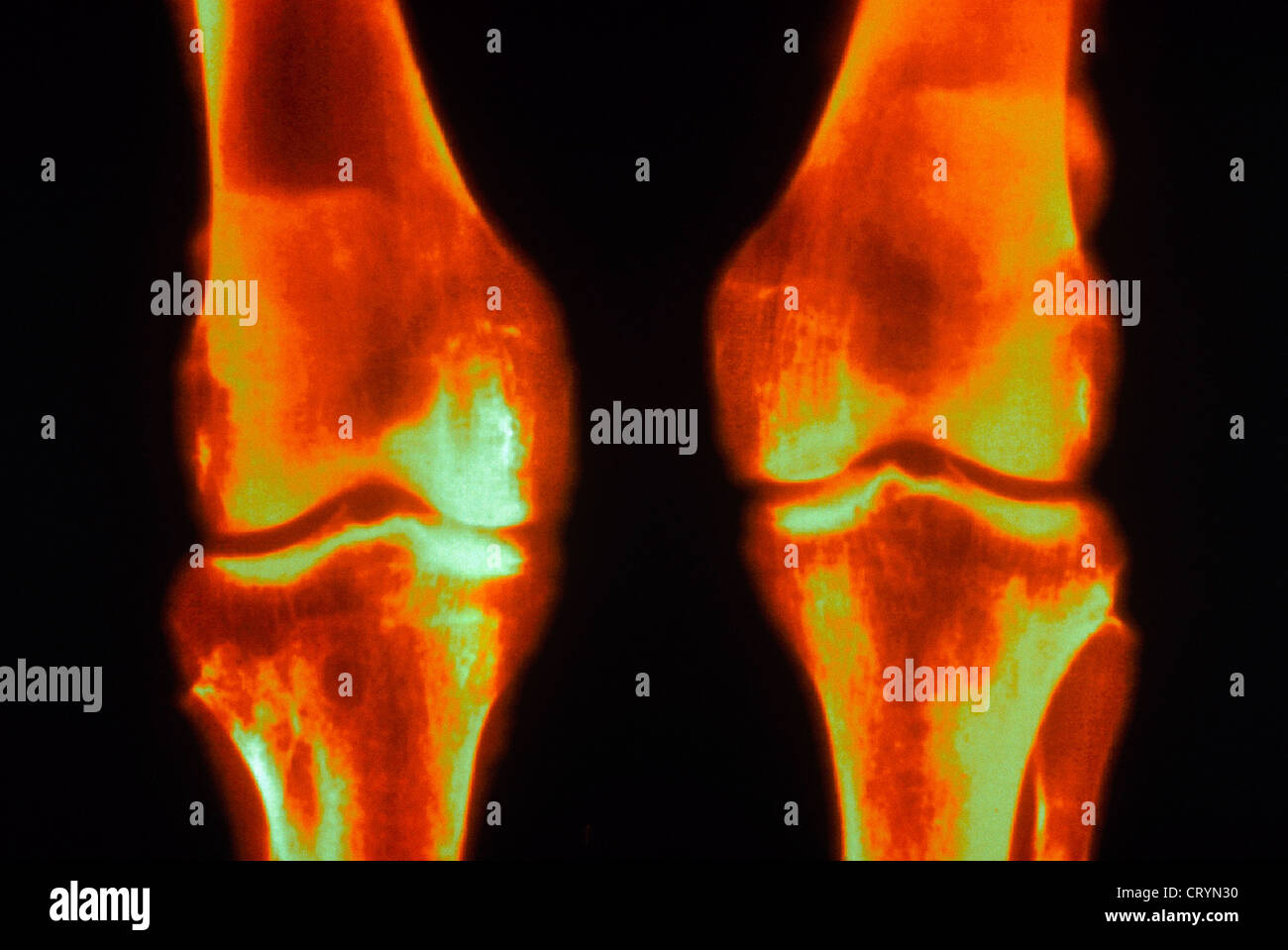 HYPERPARATHYROIDISM, XRAY Stock Photo Alamy
