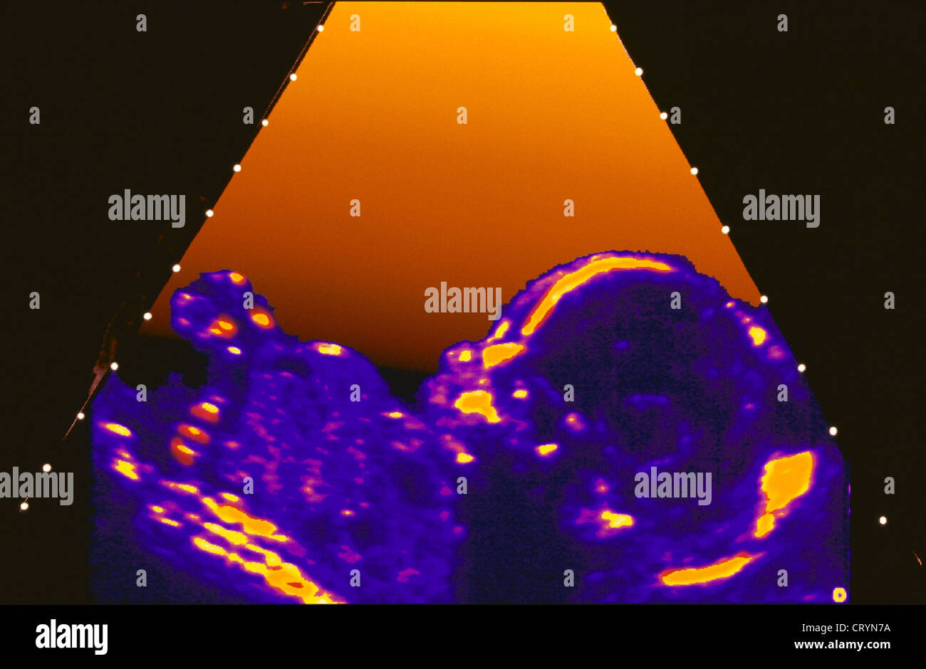 Sonogram fetus 2 months hires stock photography and images Alamy