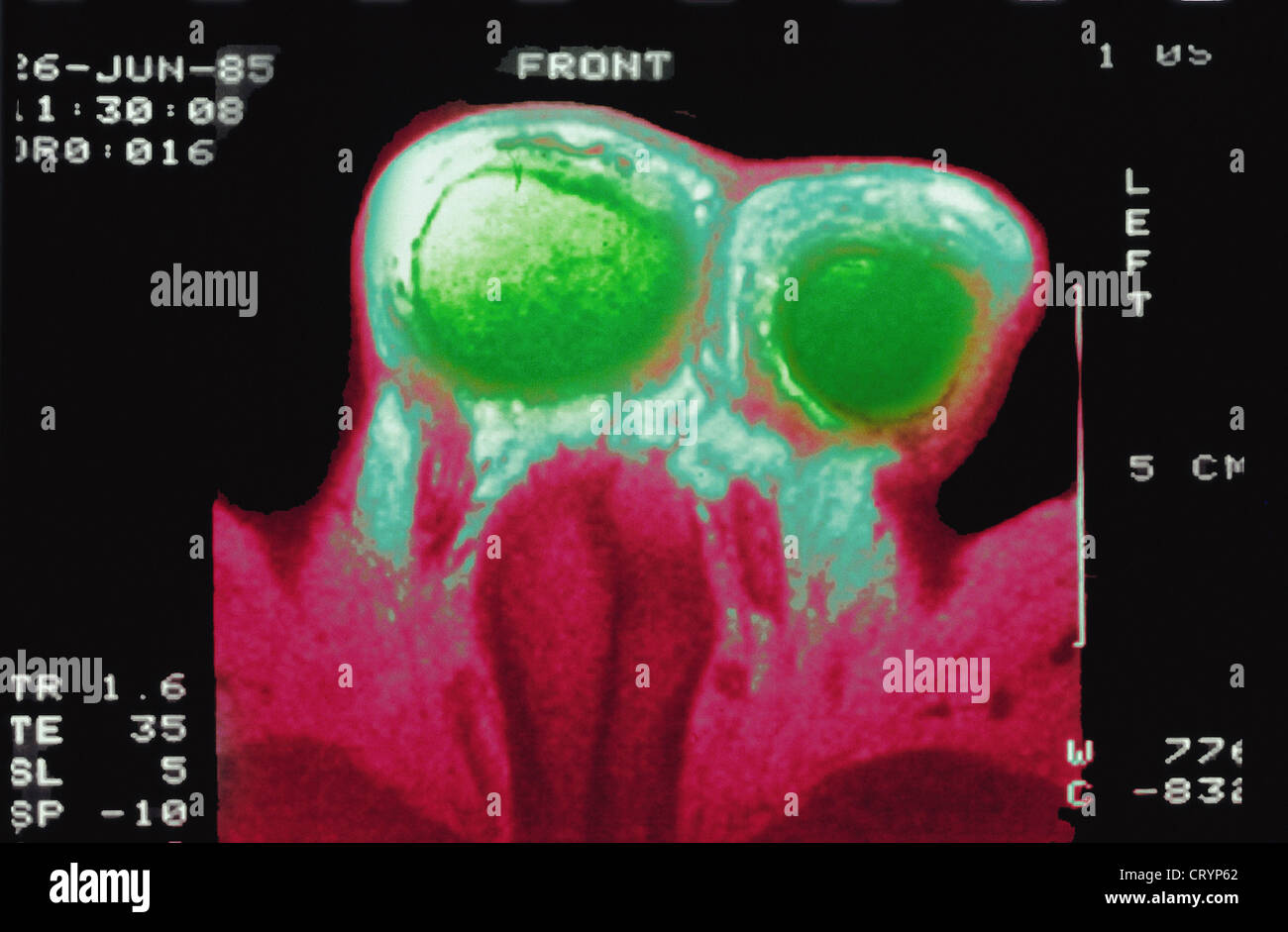 Human Testicle Stock Photos & Human Testicle Stock Images Alamy