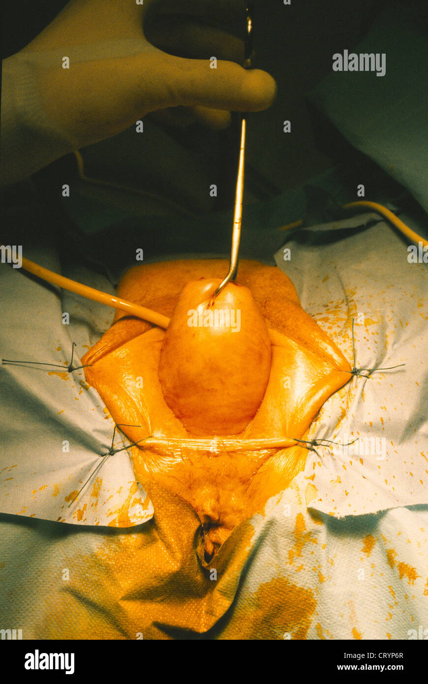 PROLAPSED UTERUS Stock Photo: 49167967 - Alamy