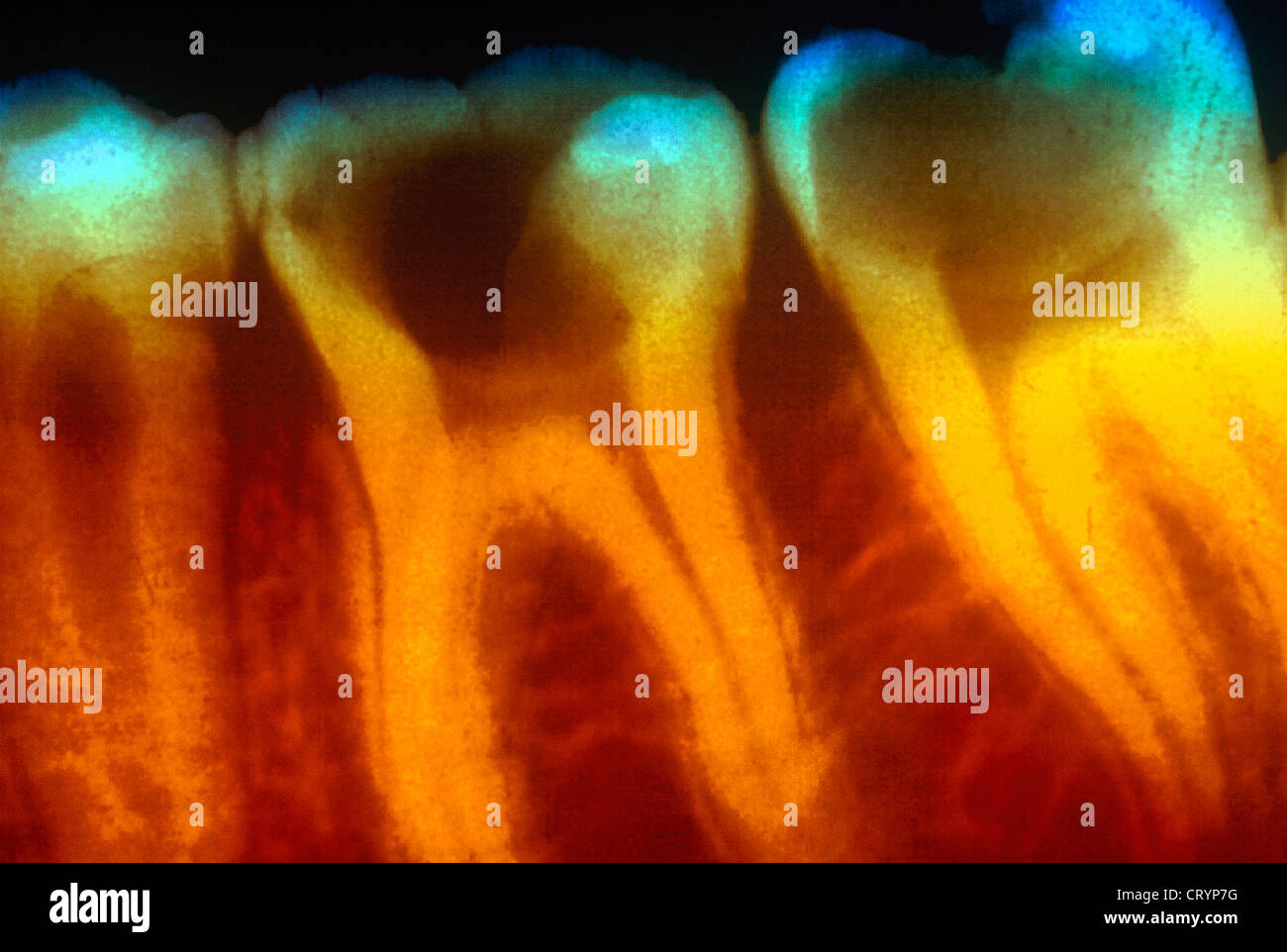TOOTH DECAY, XRAY Stock Photo Alamy