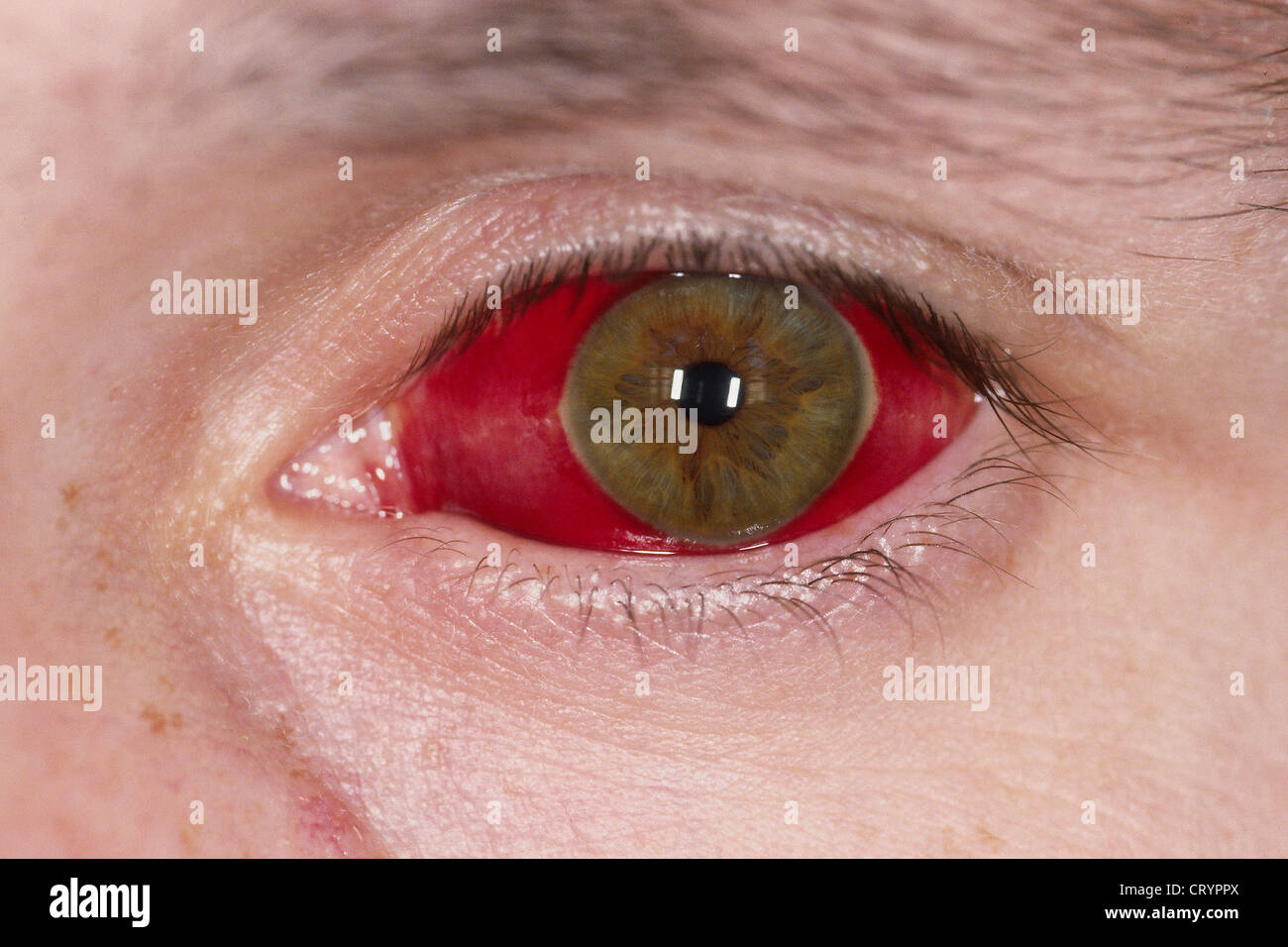 VIRAL CONJUNCTIVITIS Stock Photo