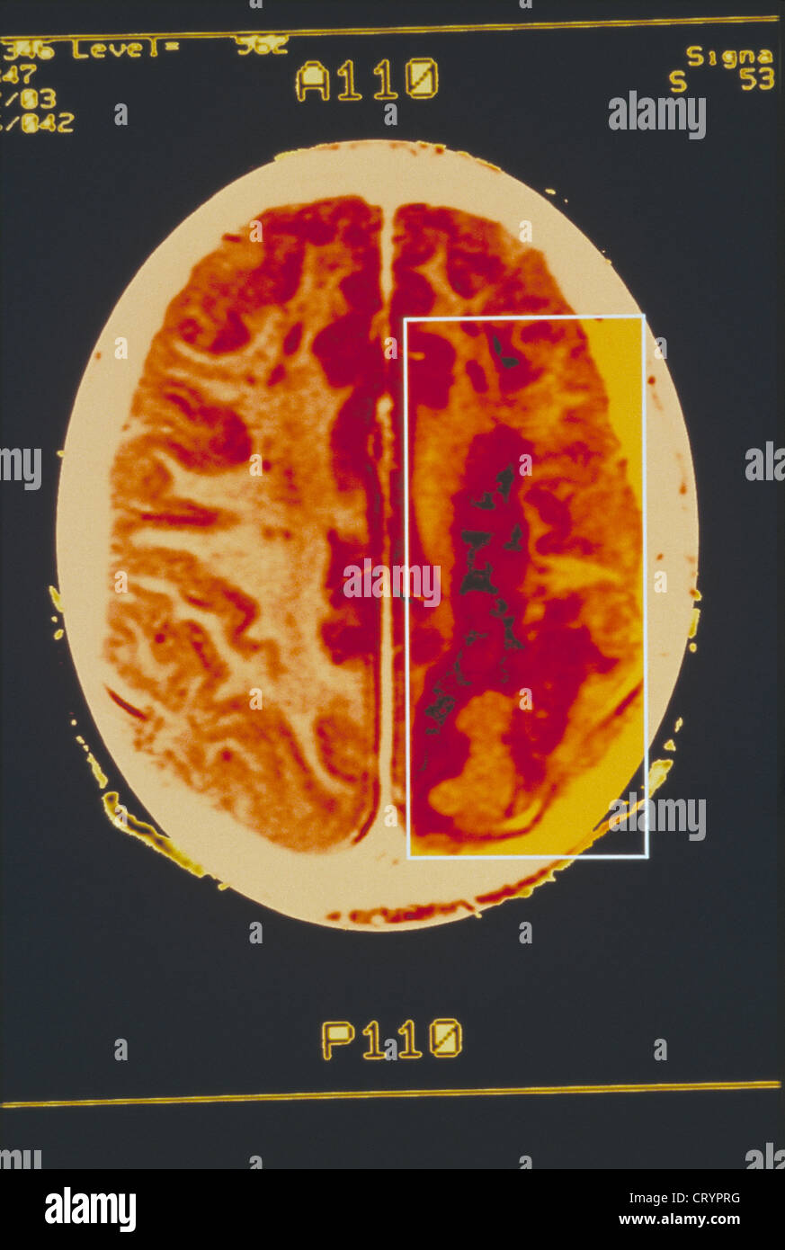 HEMORRHAGE, BRAIN SCAN Stock Photo - Alamy