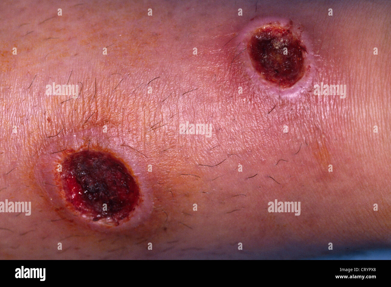 Cutaneous Leishmaniasis Stock Photos & Cutaneous Leishmaniasis Stock Images - Alamy1300 x 956