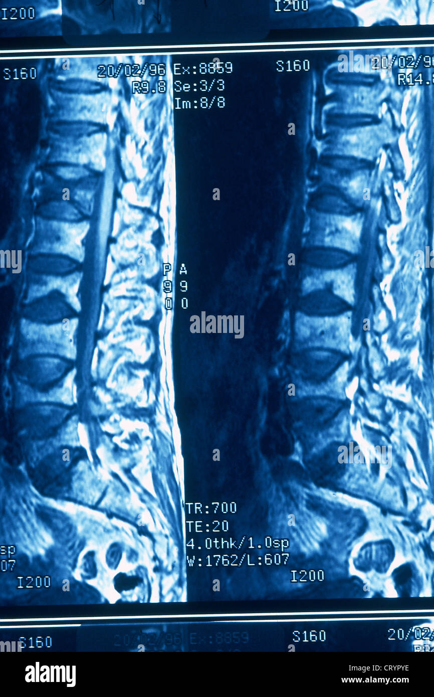 Osteoporosis bone scan hires stock photography and images Alamy