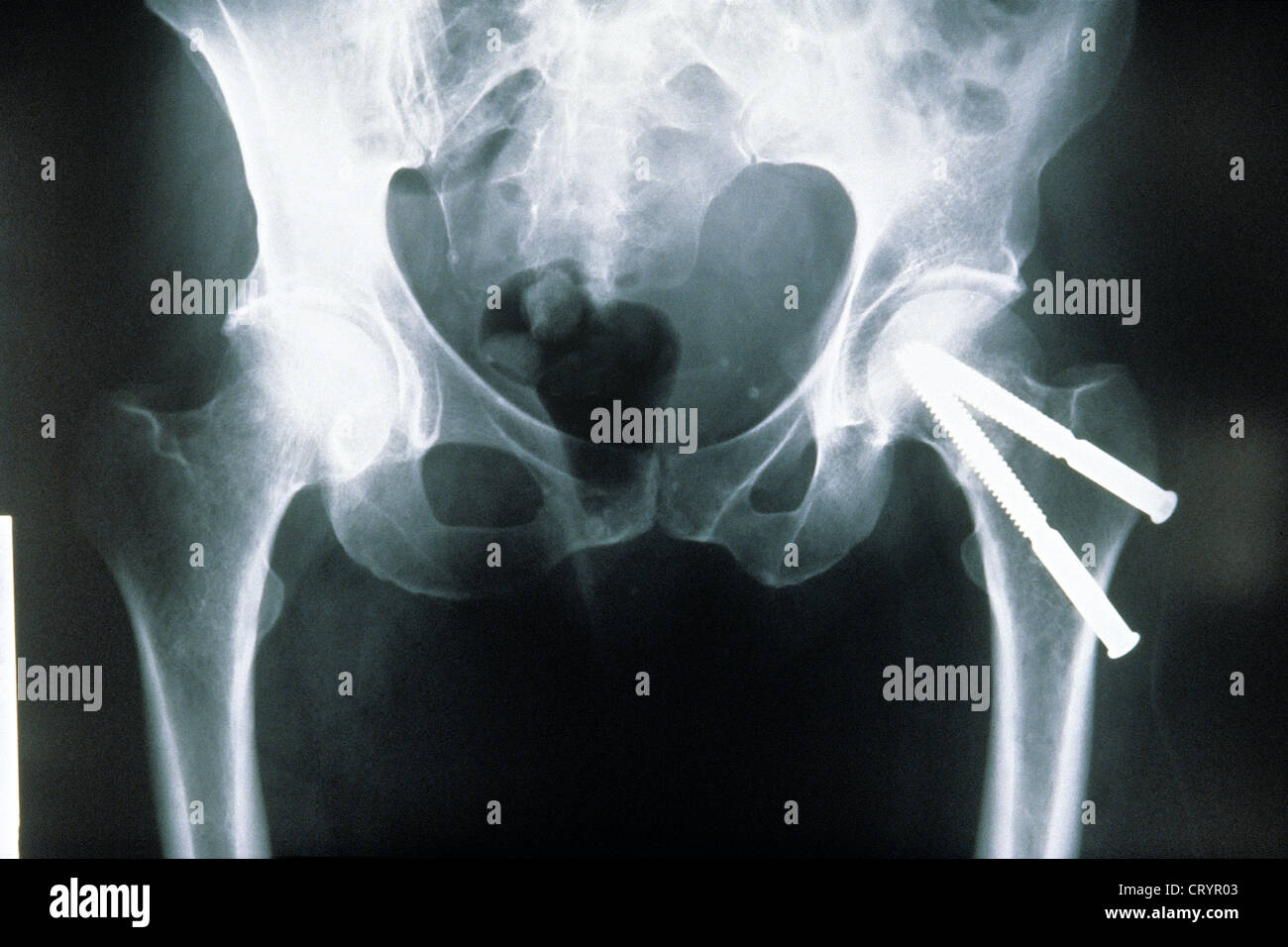 Hip osteosynthesis hi-res stock photography and images - Alamy
