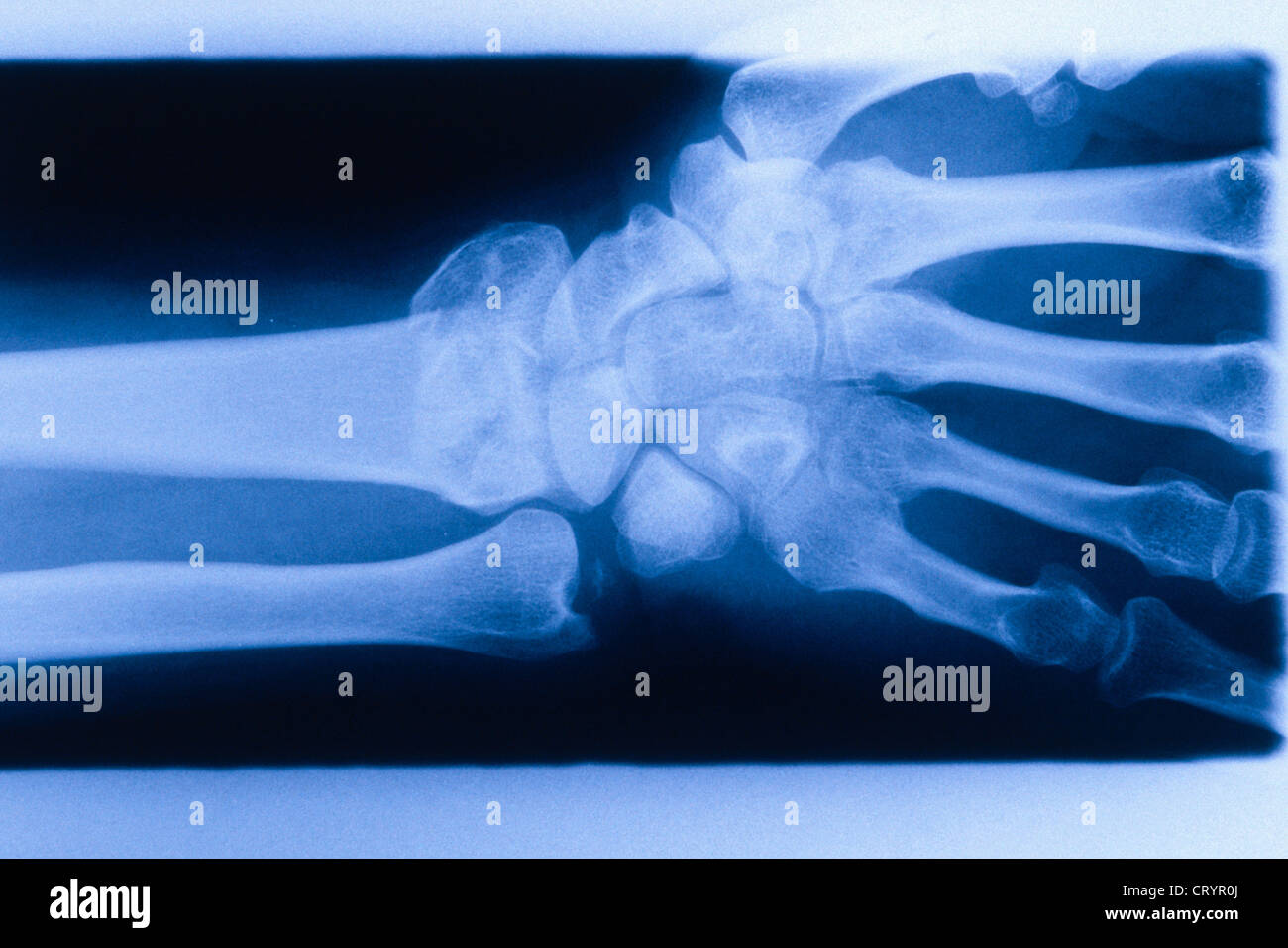 FRACTURED WRIST, XRAY Stock Photo Alamy