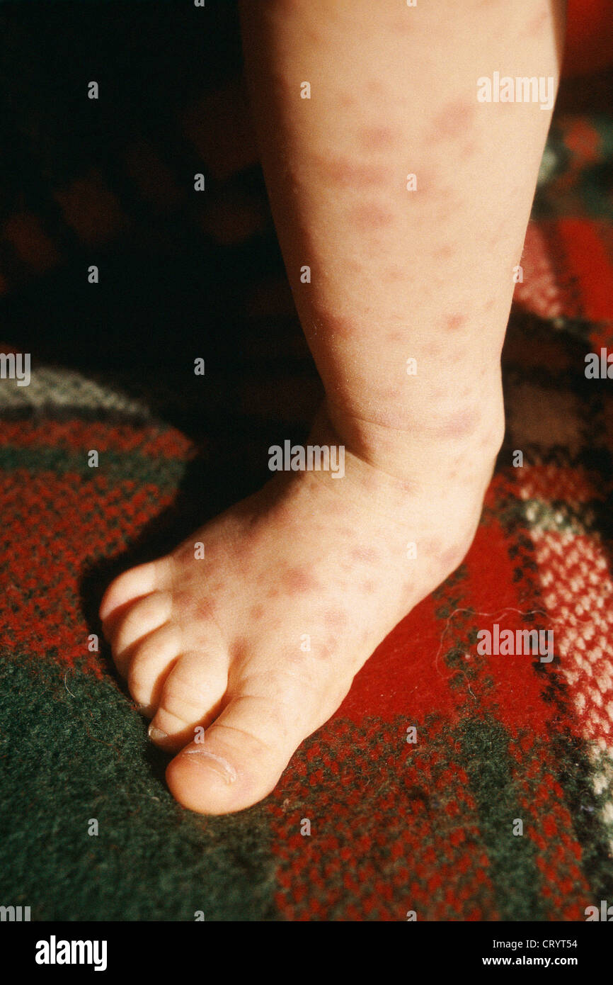 MOUTH HAND & FOOT SYNDROME Stock Photo Alamy