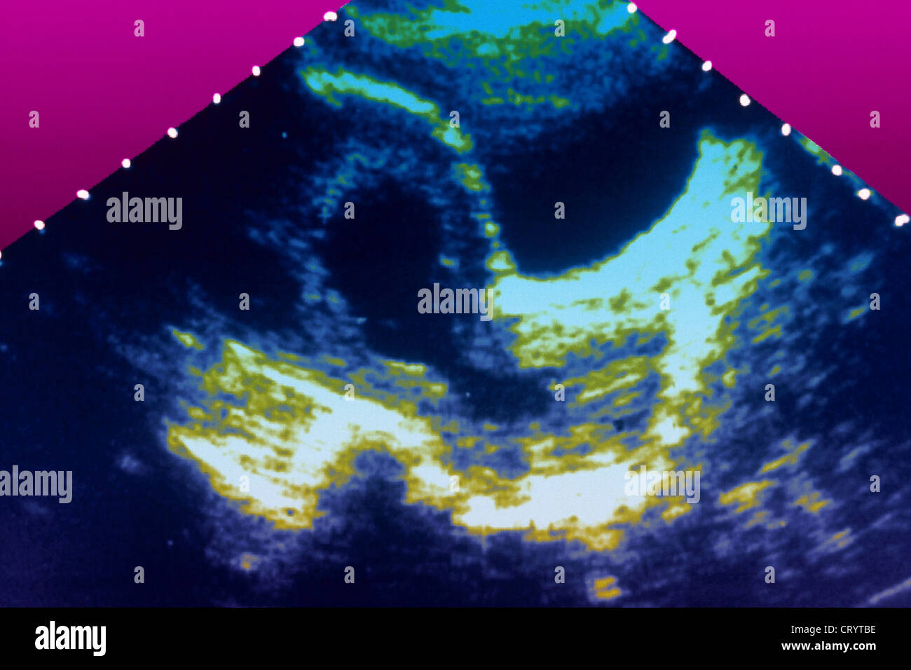 MISCARRIAGE, ULTRASOUND BIOMETRY Stock Photo
