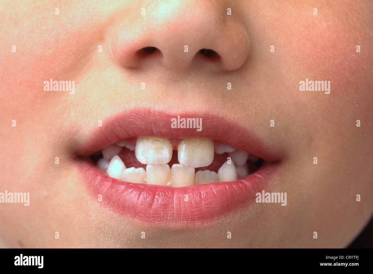 LOSING MILK TEETH Stock Photo - Alamy
