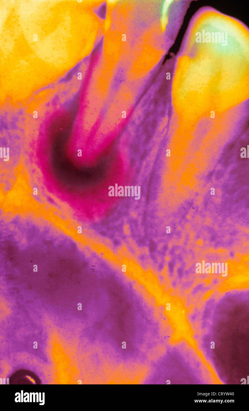 DENTAL ABSCESS, XRAY Stock Photo Alamy