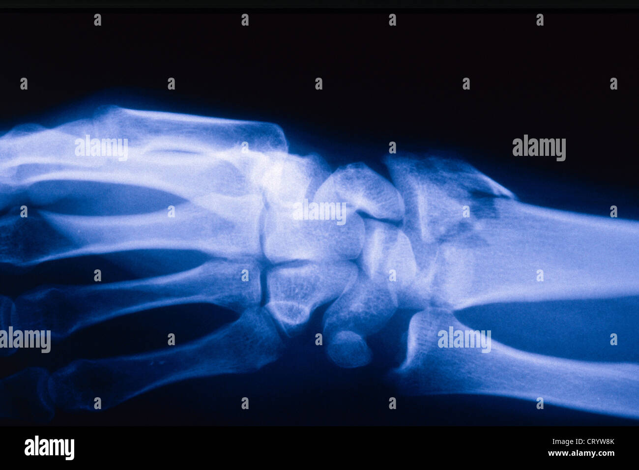 FRACTURED WRIST, XRAY Stock Photo Alamy