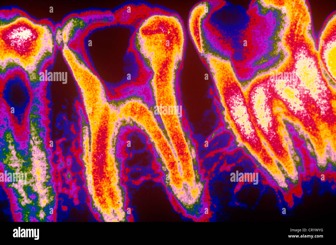 TOOTH  DECAY, X-RAY Stock Photo