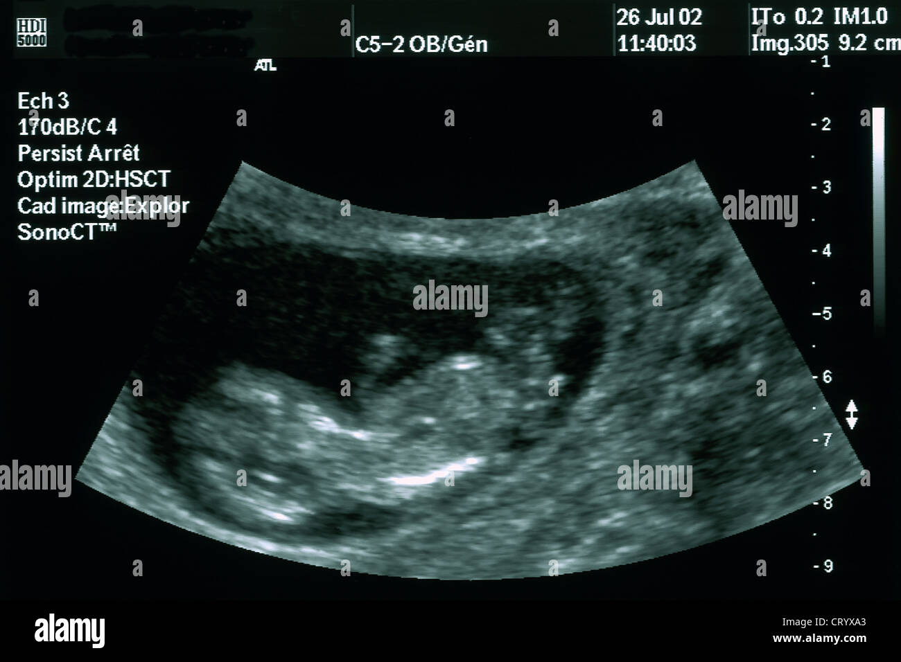 3 months fetus hi-res stock photography and images - Alamy
