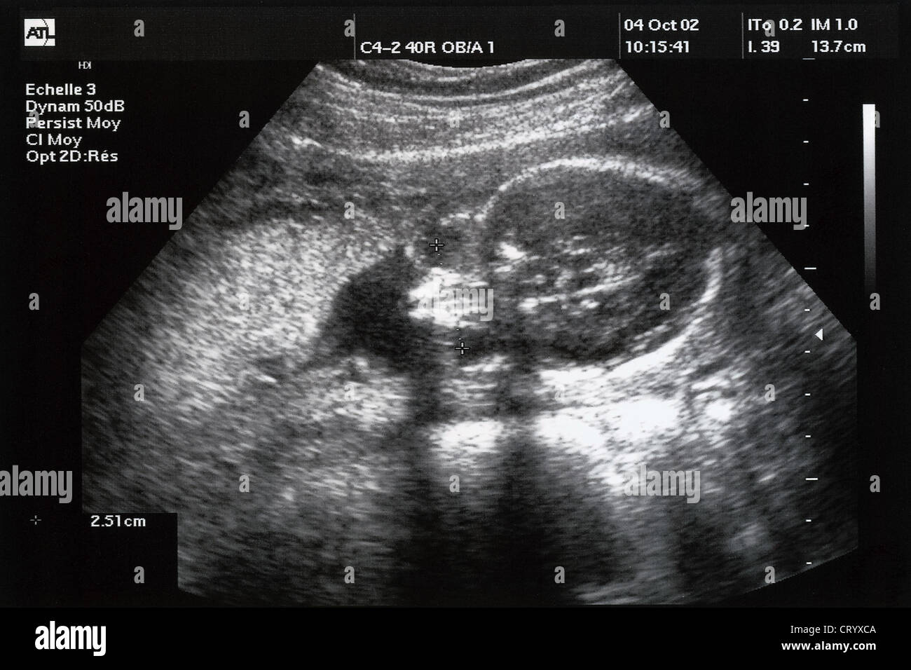 Fetus 22 weeks hi-res stock photography and images - Alamy