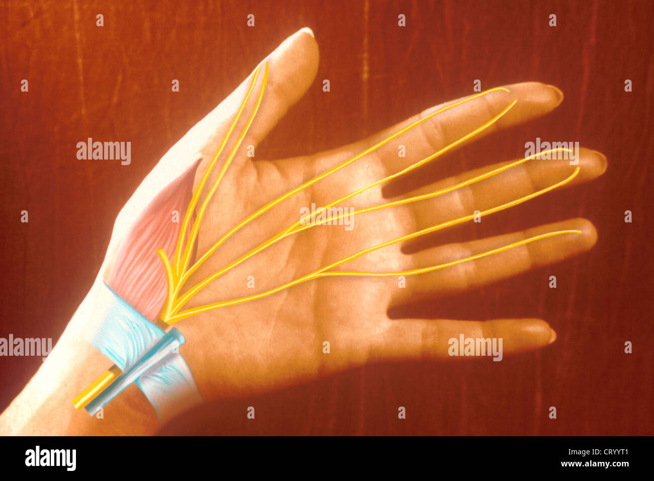 Carpal tunnel syndrome drawing hi-res stock photography and images - Alamy