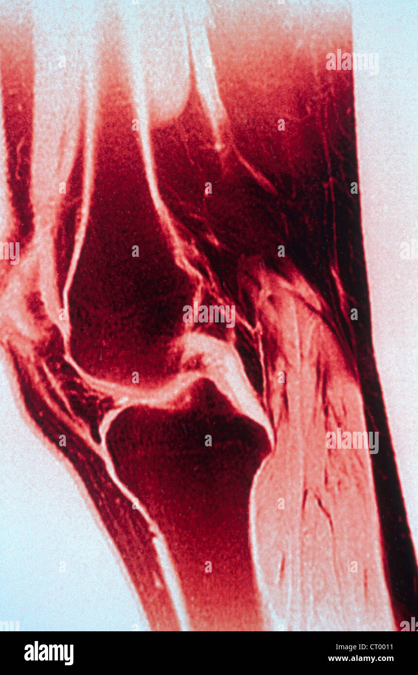 MUSCLE, MRI Stock Photo